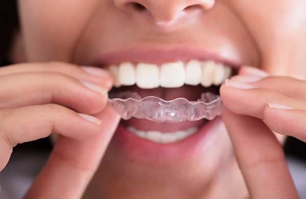 5 Reasons More Adults Are Choosing Clear Aligners Over Traditional Braces