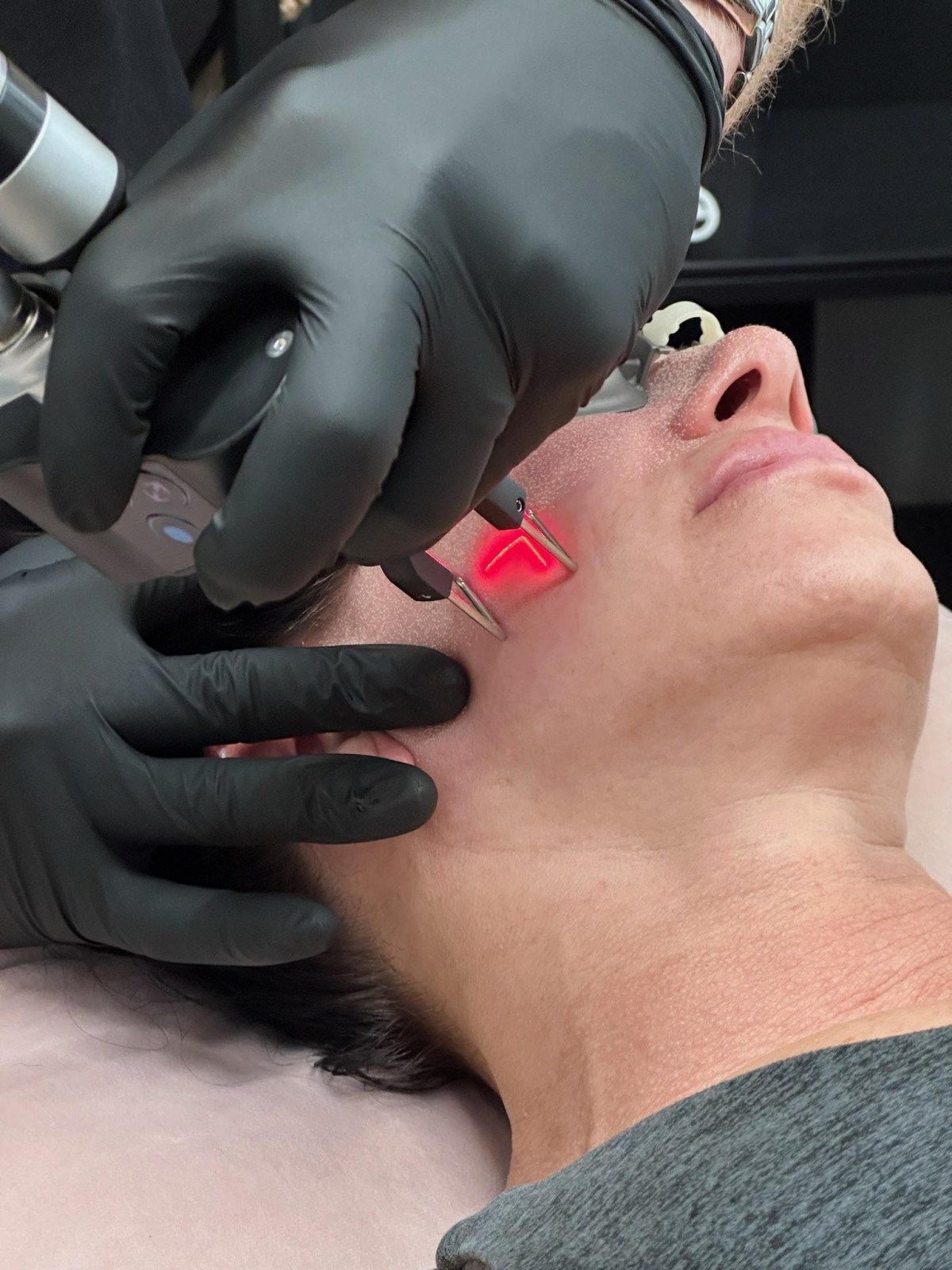 CO2 Laser Skin Resurfacing Guide in Pompano Beach (2025)